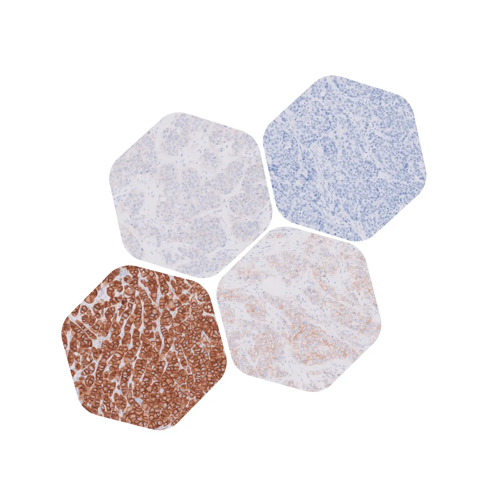 HercepTest™ mAb pharmDx (Dako Omnis)